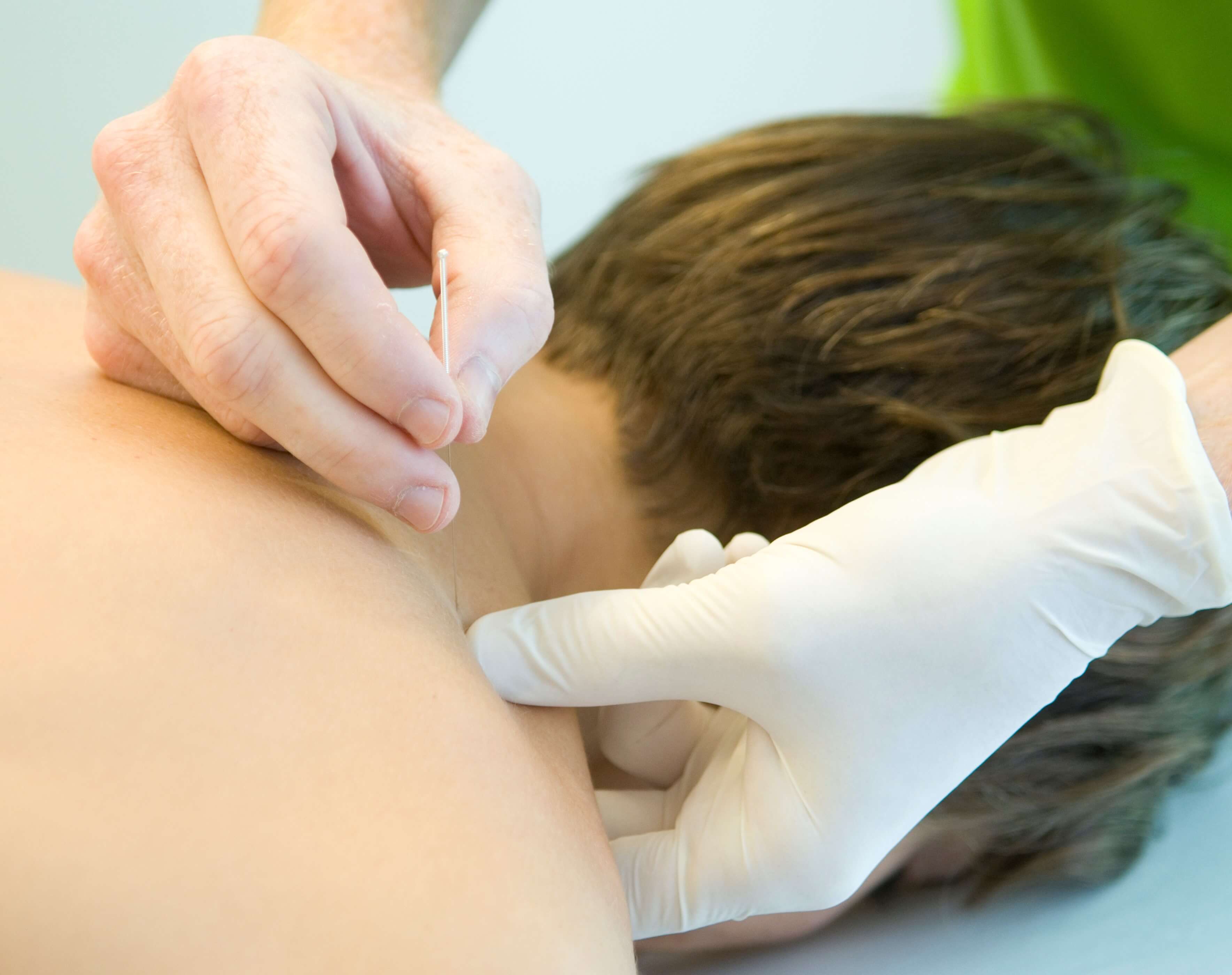 Punción seca | Centre Kine