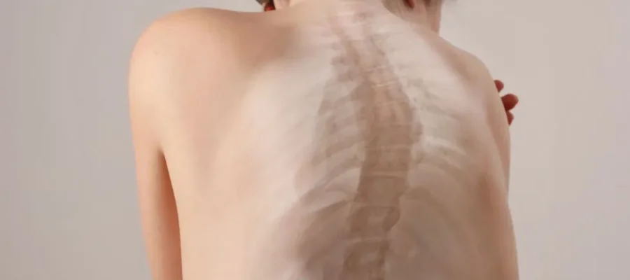 síntomas y tratamiento de la escoliosis