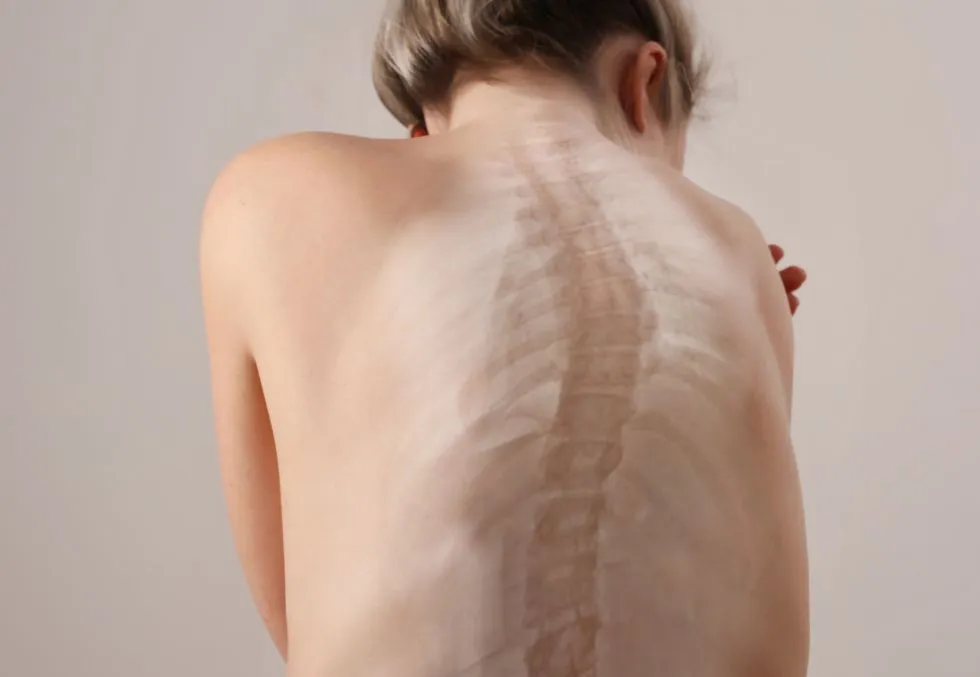 síntomas y tratamiento de la escoliosis